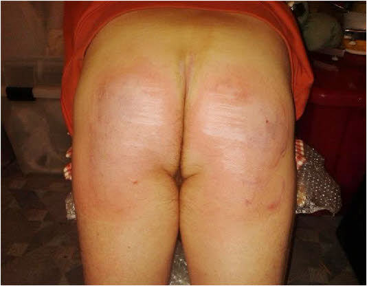 Male sub with cane marks received at British spanking party